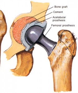 Hip Replacement Surgery in India