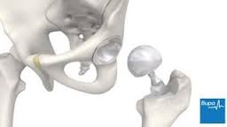 Hip Replacement Surgery in India