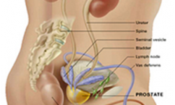 Prostate cancer treatment in India